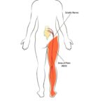 sciatica