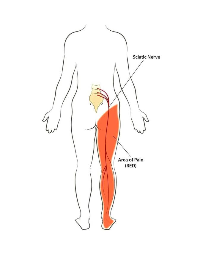 sciatica